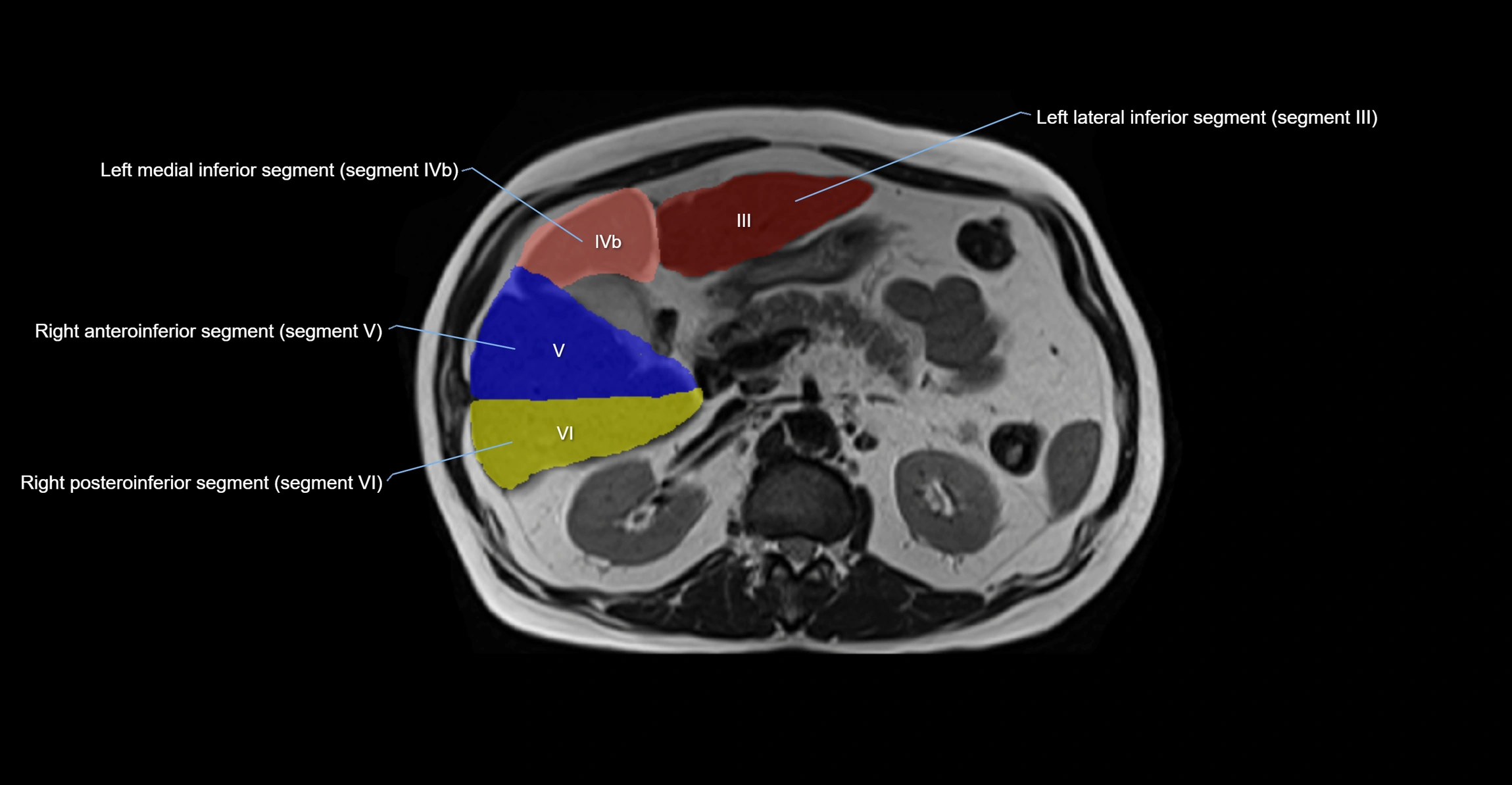 MRI  liver segments anatomy axial cross sectional 3T radiology  image-img-00001-00018.webp